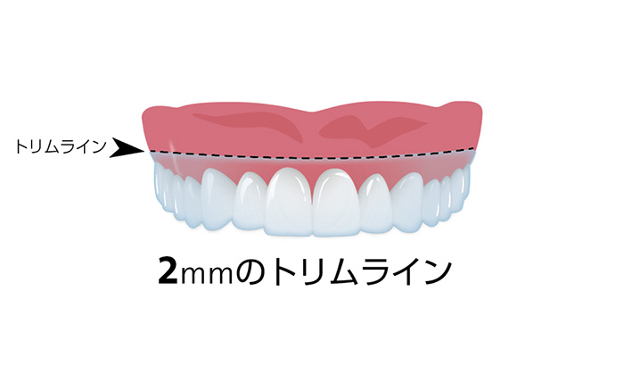 2mmのトリムライン